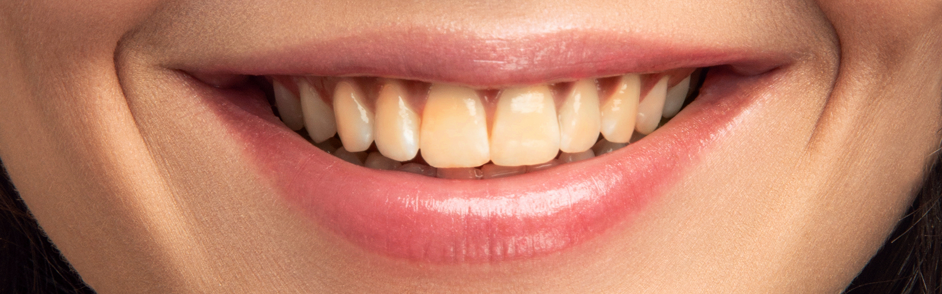 Can Yellow Teeth Turn White Again?