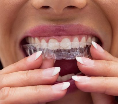 Top 5 Benefits of Choosing Invisalign for Teeth Straightening
